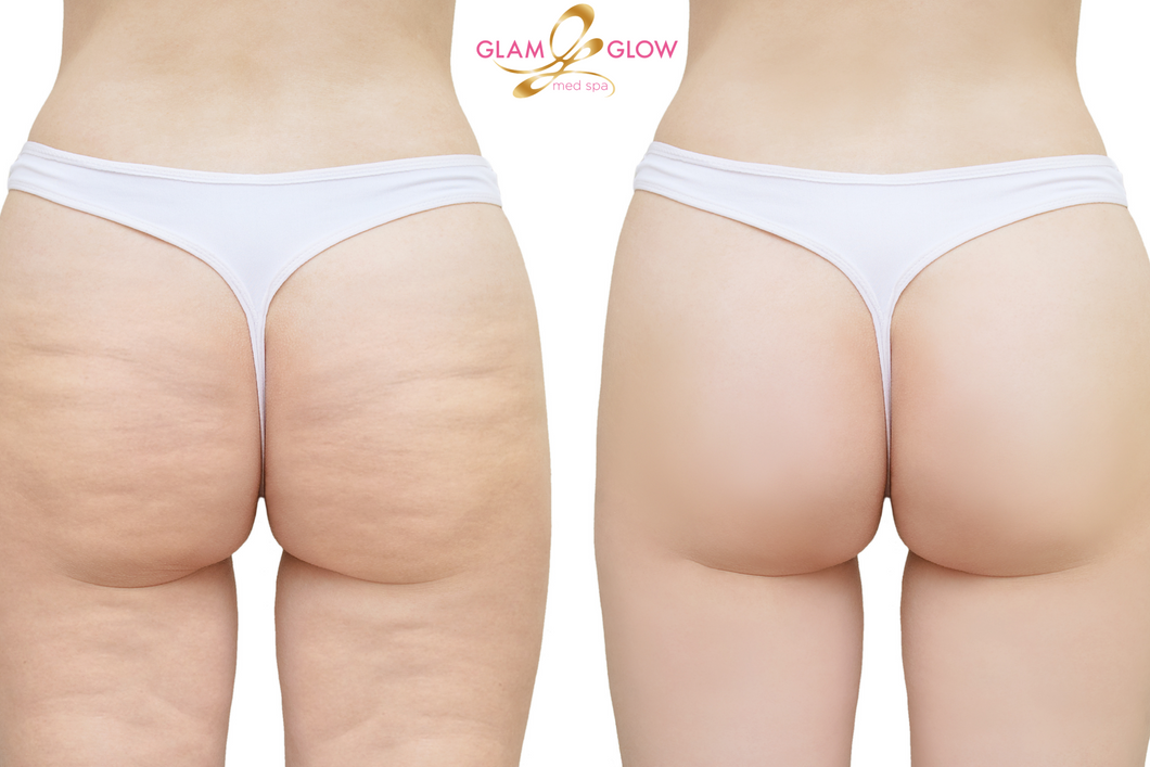 Cellulite Treatment- 10 Pack