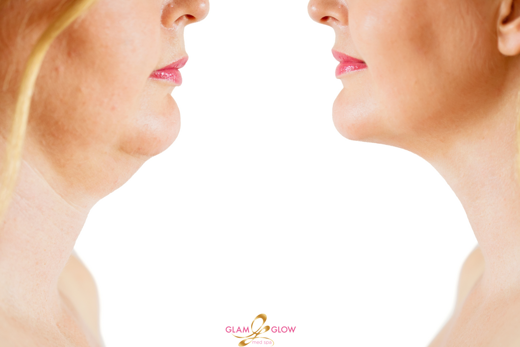 Kybella - Nonsurgical Face Lift