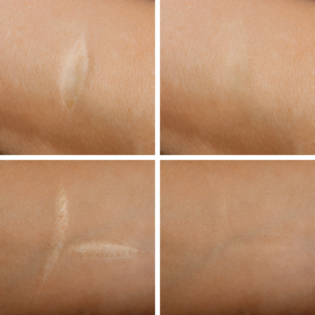 Scar Removal