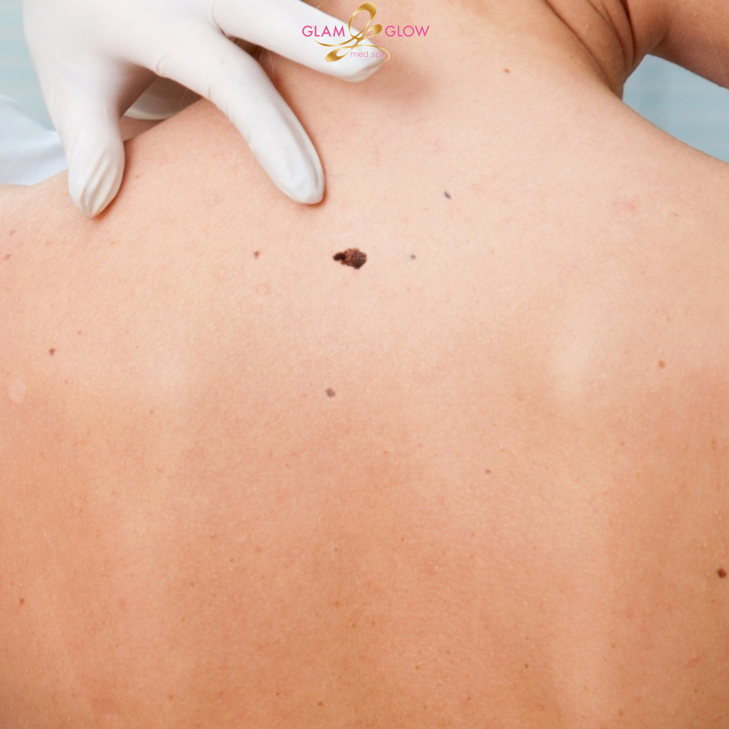 Skin Tag Removal